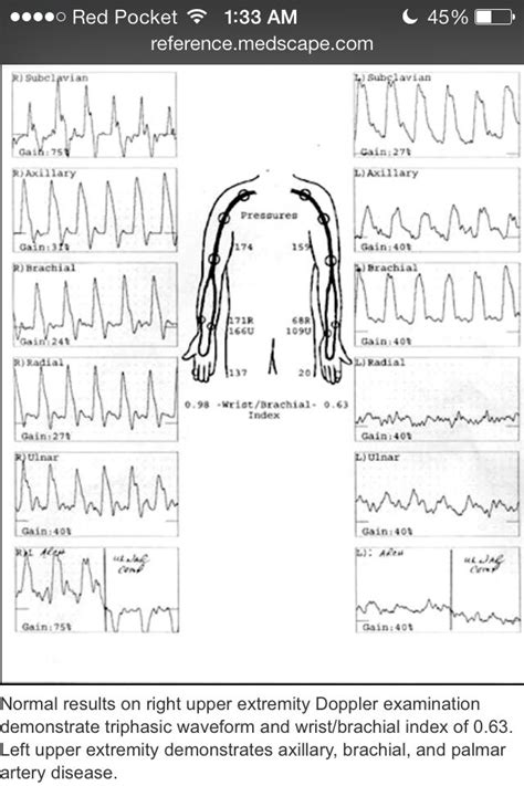 Vascular Ultrasound Case Upper Extremity Arterial Pvr Segmental