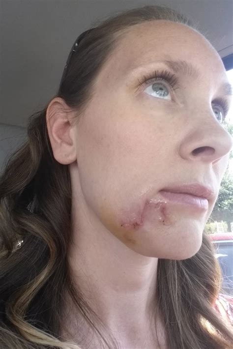 Woman Thought Gaping Hole Was Just Blackhead But It Was Deadly Skin Cancer Metro News