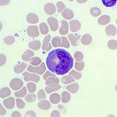 Immature Granulocytes Blood Film Medschool
