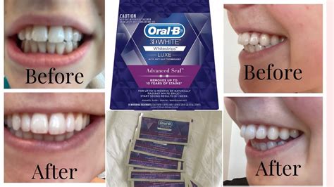 Discover The Amazing Results Of Oral B Teeth Whitening Strips