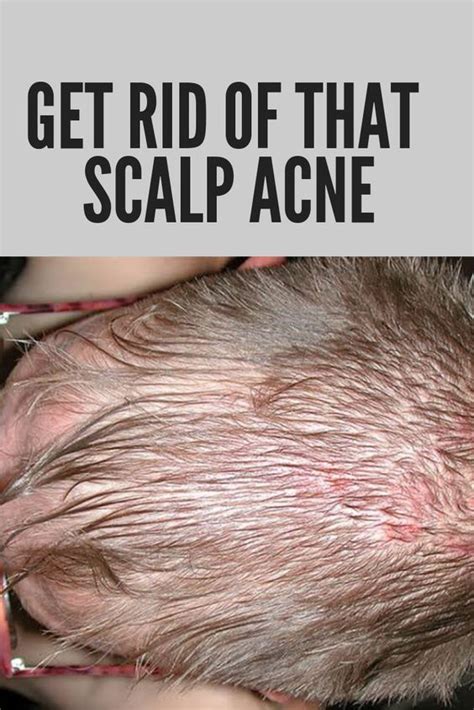 Scalp Pimples What Causes Them And How To Treat Them Scalp Acne