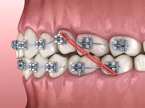 Importance of Elastics With Orthodontic Treatment - Maddux Orthodontics