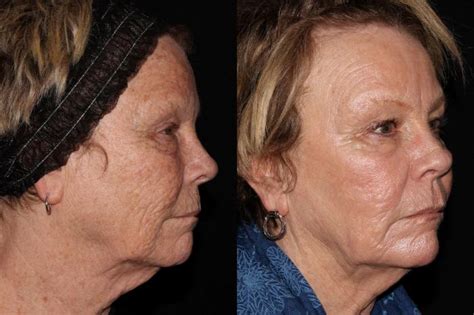 Profractional Laser Resurfacing Before And After Pictures Case 43