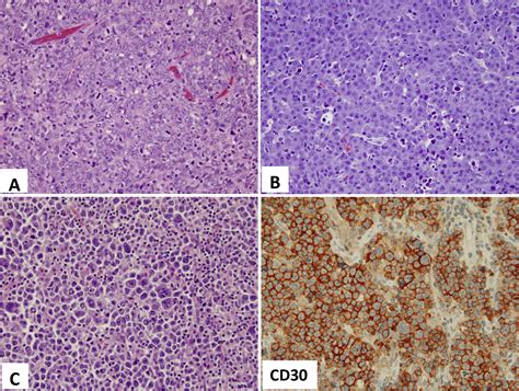 Diffuse Large B Cell Lymphoma Pathology