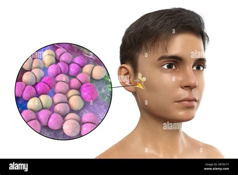 Otitis Media Ear Infection Caused By Streptococcus Pneumoniae Bacteria