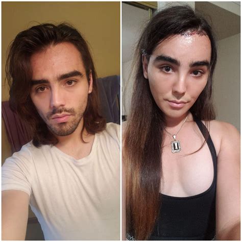 Pre Everything Left Vs 14 Months Hrt And 2 Weeks Post Ffs Right