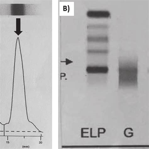 Serum Protein Electrophoresis And Immunofixation Electrophoresis
