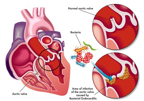 Endocarditis Drcraghu