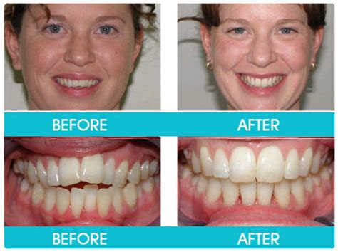 Free shipping on orders over $25 shipped by amazon. Braces Before and After / Invisible Aligners Before and After