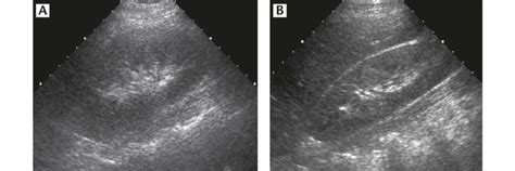 Hydronephrosis in pregnancy diagnosis and management of acute pyelonephritis in adults. Diffuse acute pyelonephritis in a 31-year-old woman. (A ...