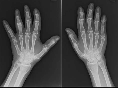 A Patients Guide To Osteoarthritis Of The Hand Hand And Upper Limb