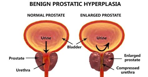 What Is Enlarged Prostate Causes Symptoms Treatment And More