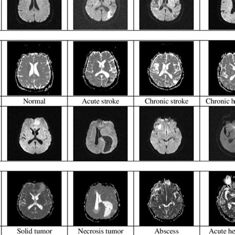 Pdf Review Of Brain Lesion Detection And Classification Using