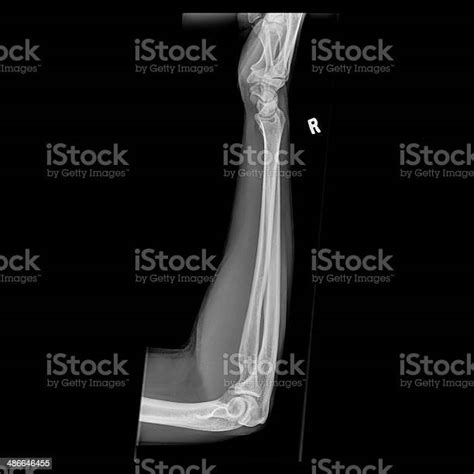 Xray Top View Of Human Forearm Stock Photo Download Image Now Bone