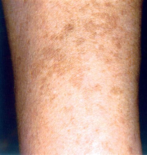 Dark Spots On Skin Arms
