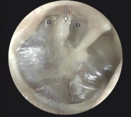 Retracted Tympanic Membrane