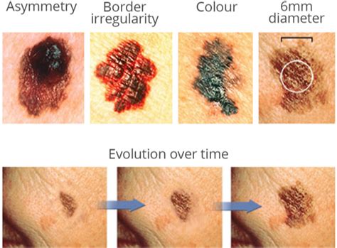 Typical Morphological Characteristics Of A Malignant Skin Lesion