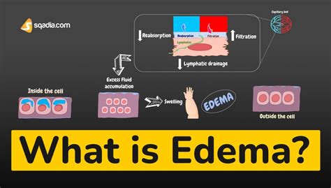 What Is Edema Pathophysiology