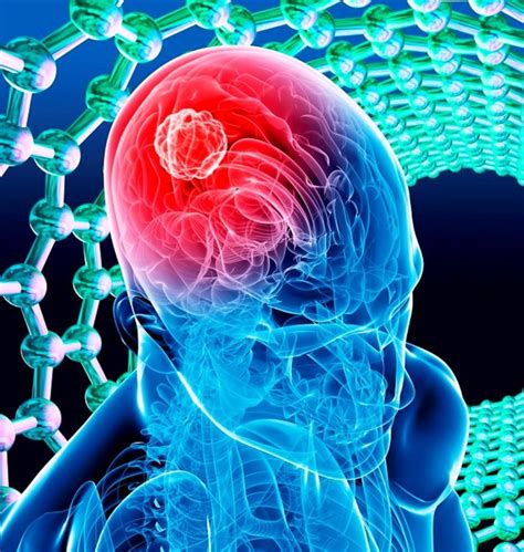 Causas De Un Tumor En El Cerebro Todo Lo Que Debes Saber