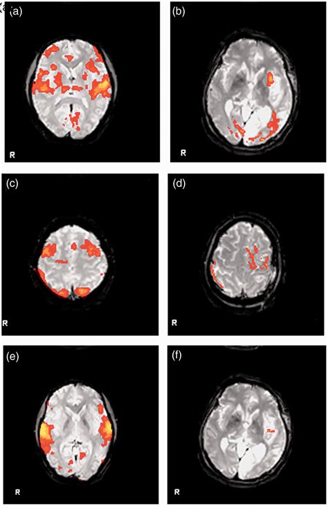Effect Of Amantadine On Vegetative State After Traumatic Brain Injury