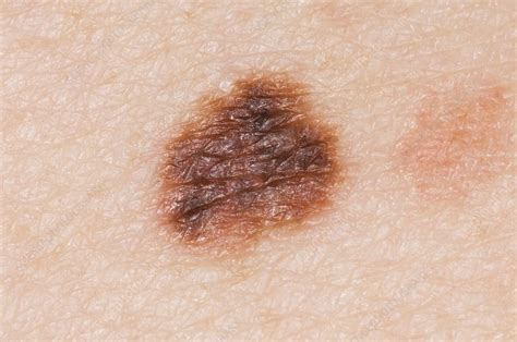 Atypical Naevus Mole On The Skin Stock Image C0090078 Science