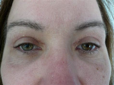 Blepharoplsty Eyelid Tightening Post Op • Cosmetic Surgery Excellence