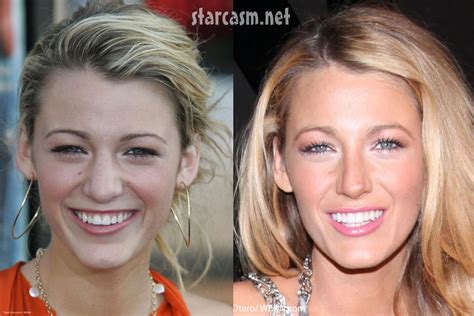 Blake Lively S Nose Job Before And After Plastic Surgery Photos