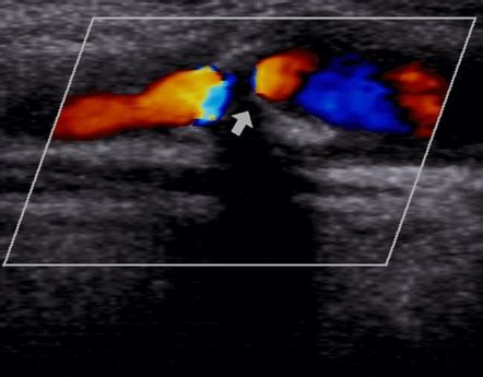 Ultrasound Carotid Stenosis Chart