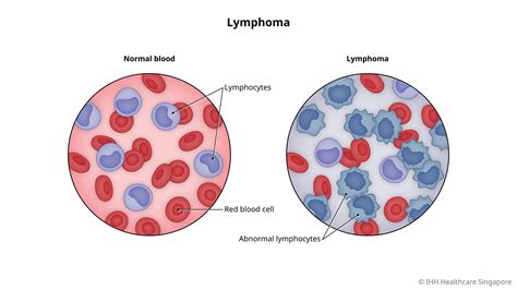Lymphoma Symptoms And Causes Gleneagles Hospital
