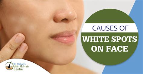 What Causes White Patches On Your Lips