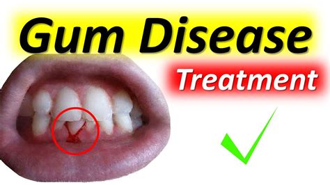 How To Cure Gum Disease Fast At Home Top 5 Natural Remedies For Gum
