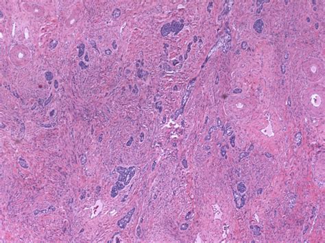 Scanning Magnification View Of A Pure Adenoid Basal Lesion Adenoid