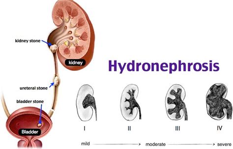 Hydronephrosis Renal Er Rosh Review Sonography Student Renal