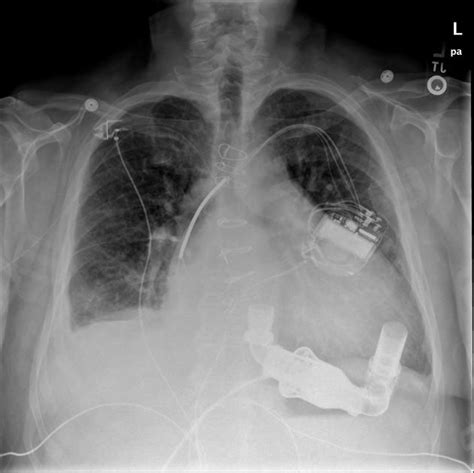 Chest X Rays Demonstrate An Implantable Cardioverter Defibrillator