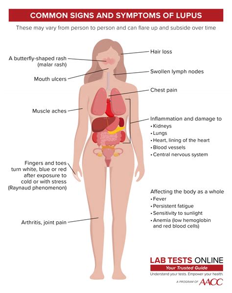Posted on november 21, 2020. Lupus | Lab Tests Online