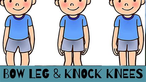 Bow Leg And Knock Knees In Children When Is It Normal And When Should