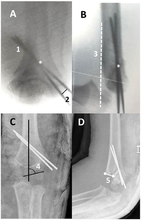 Lateral Only Kirschner Wire Fixation Of Type 3 Supracondylar Humerus