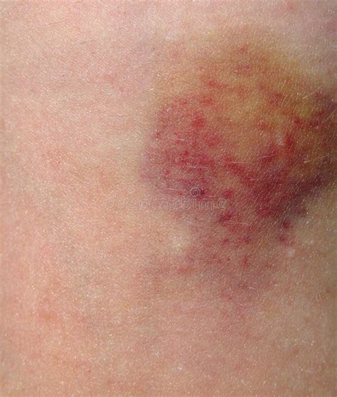 Bruised Woman Skin Stock Image Image Of Disease Discoloration 15409903