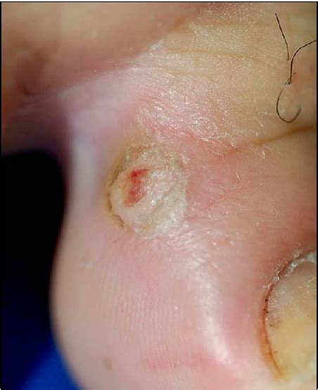 Figure 2 From A Case Of Digital Myxoid Cyst Coexisting With Epidermal