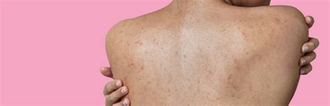 Back Acne Causes Symptoms And Treatments Skn Clinics