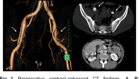Figure From Bilateral External Iliac Artery Dissection In A Middle