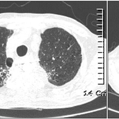 Microscopic Finding Of Transbronchial Lung Biopsy Shows Interstitial