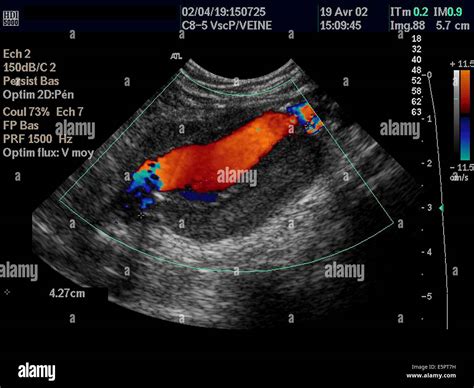 Color Doppler Ultrasound Scan Of An Aneurysm Of The Abdominal Aorta