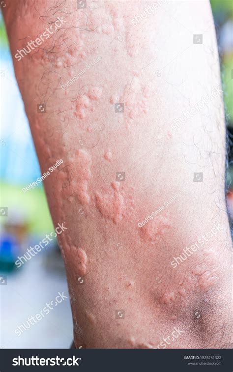 Urticaria On Skin Rashes Which Urticaria Stock Photo 1825231322