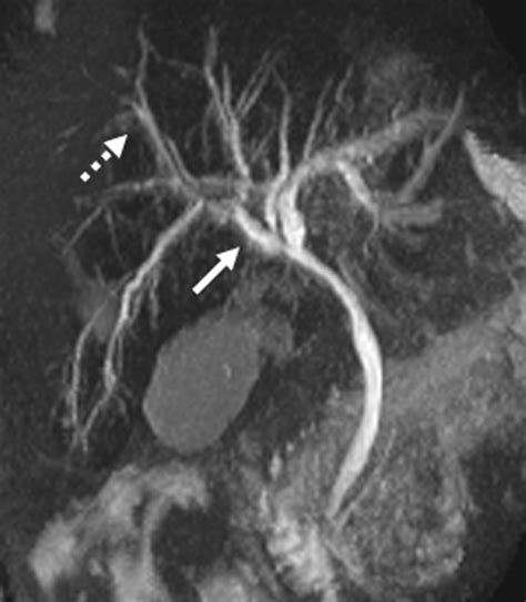 Full Text Benign Biliary Stricture And Its Rare Association—mirizzi