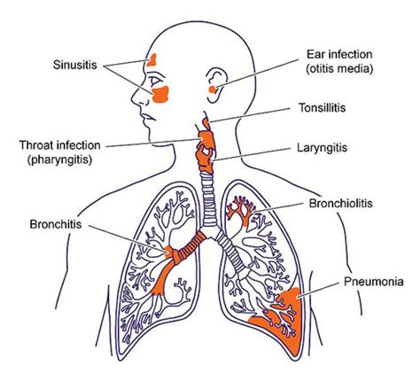 Respiratory Tract Infection Rti Is Defined As Any Infectious D