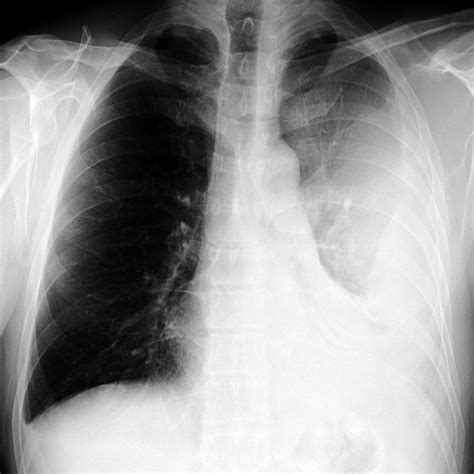 Treatment depends on the cause. Large, Loculated Pleural Effusion | Pleural effusion ...