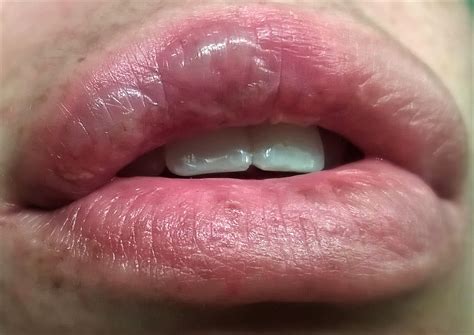 Water Blister On Lips Pictures Photos