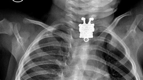 X Rays From Radiopaedia Show Objects In Strange Places The Advertiser