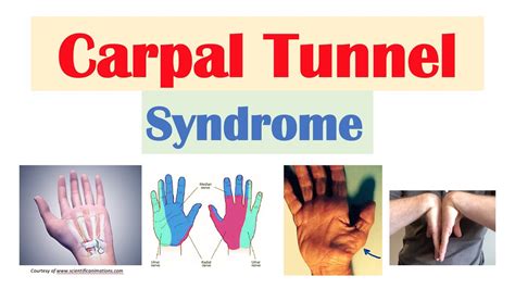 Carpal Tunnel Syndrome Causes Symptoms Risk Factors Treatment My XXX Hot Girl